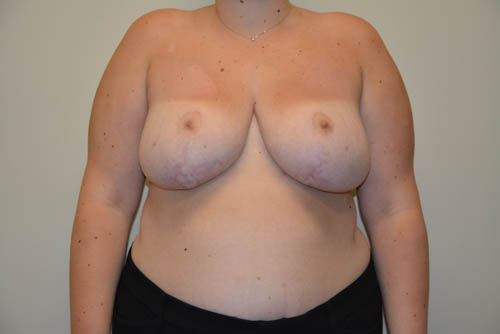Breast-Reduction-16 | After Breast Reduction