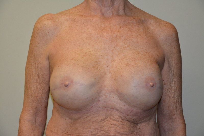 Breast-Reconstruction-Tissue-Expanders-16 | After Breast Reconstruction Tissue Expanders