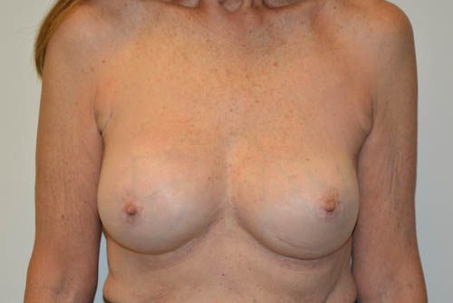 Breast-Revision-16 | After Breast Revision