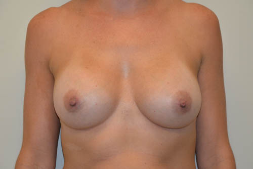 Breast-Augmentation-16 | After Breast Augmentation