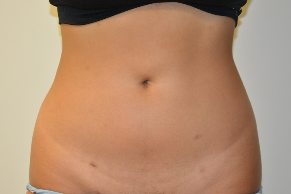 Liposuction-10 | After Liposuction