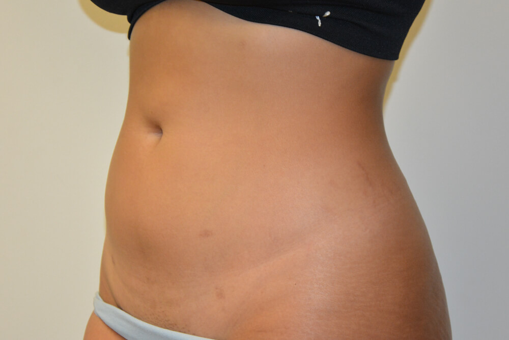 Liposuction-10 | After Liposuction 2