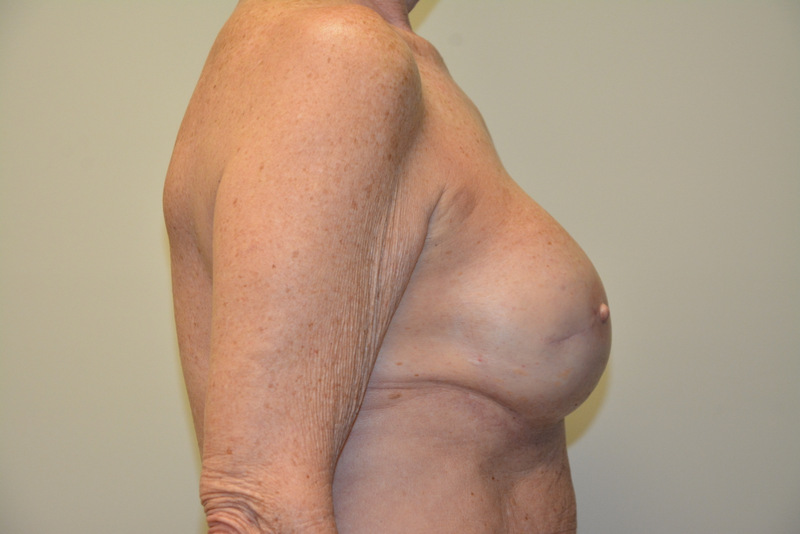 Breast-Reconstruction-Tissue-Expanders-16 | After Breast Reconstruction Tissue Expanders 3