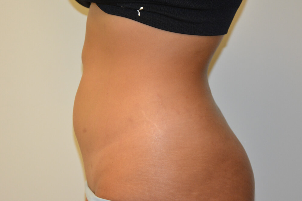 Liposuction-10 | After Liposuction 3
