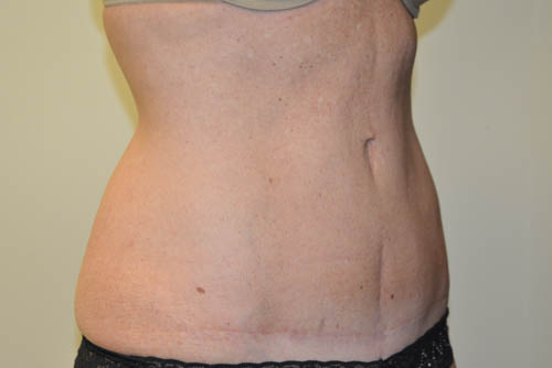 Tummy-Tuck-16 | After Tummy Tuck 2