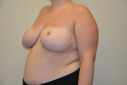 Breast-Reduction-16 | After Breast Reduction 2