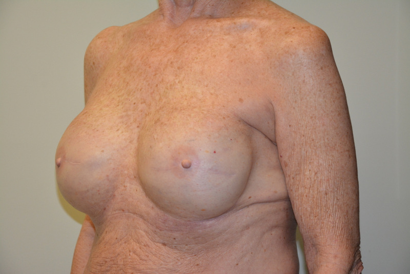 Breast-Reconstruction-Tissue-Expanders-16 | After Breast Reconstruction Tissue Expanders 5