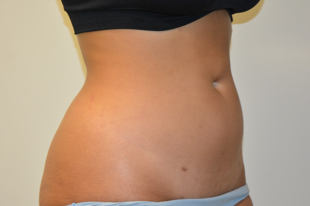 Liposuction-10 | After Liposuction 4