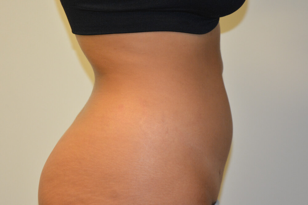 Liposuction-10 | After Liposuction 5