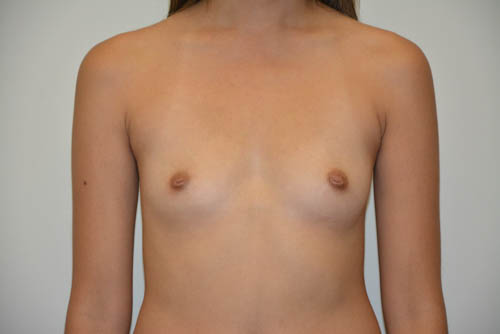 Breast-Augmentation-17 | Before Breast Augmentation