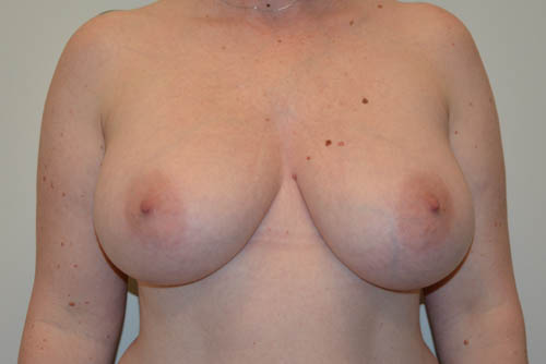 Breast-Reduction-17 | Before Breast Reduction