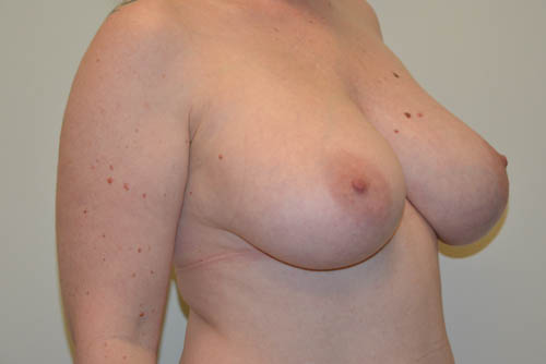 Breast-Reduction-17 | Before Breast Reduction 2