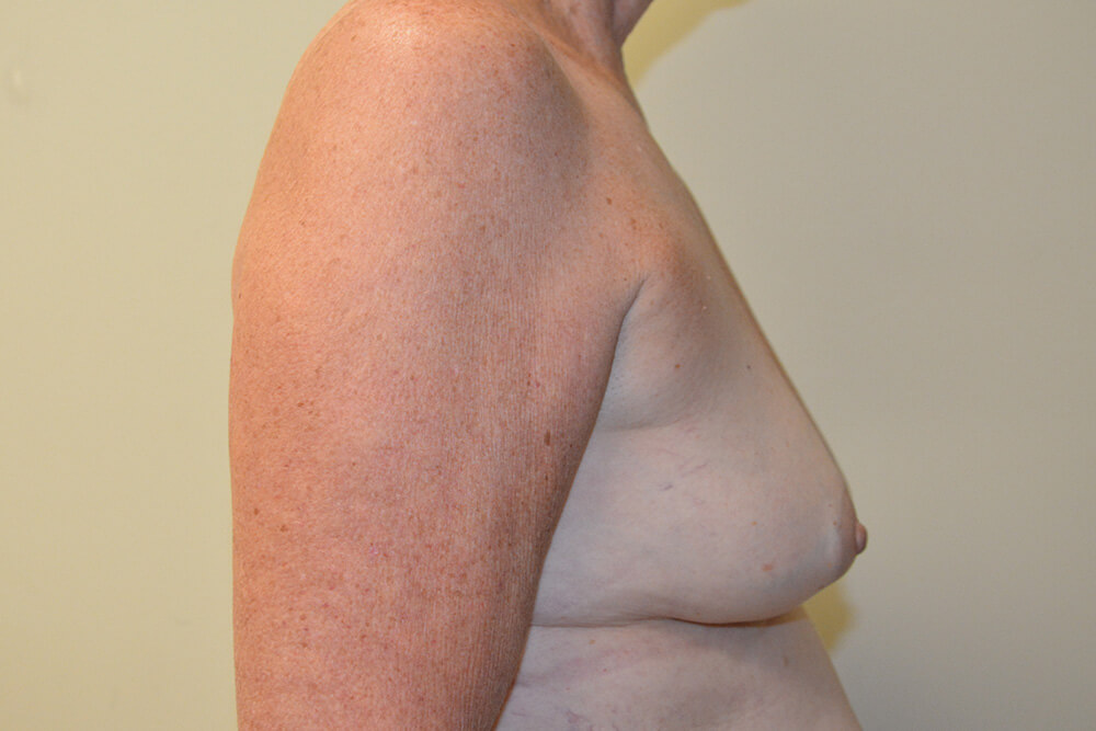 Breast-Reconstruction-Tissue-Expanders-17 | Before Breast Reconstruction Tissue Expanders 3