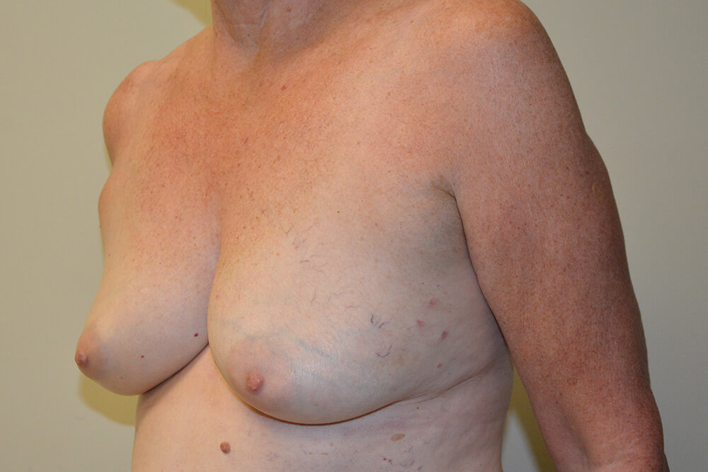Breast-Reconstruction-Tissue-Expanders-17 | Before Breast Reconstruction Tissue Expanders 4