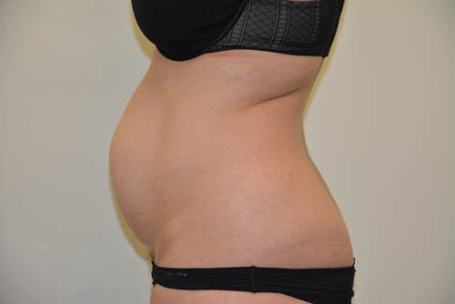 Tummy-Tuck-17 | Before Tummy Tuck 4