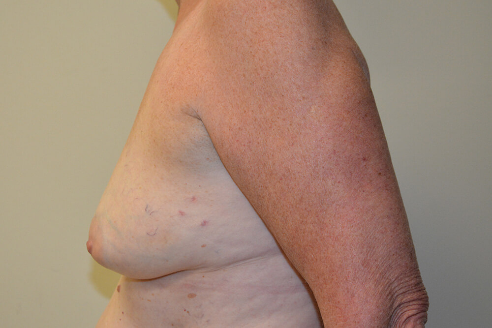 Breast-Reconstruction-Tissue-Expanders-17 | Before Breast Reconstruction Tissue Expanders 5