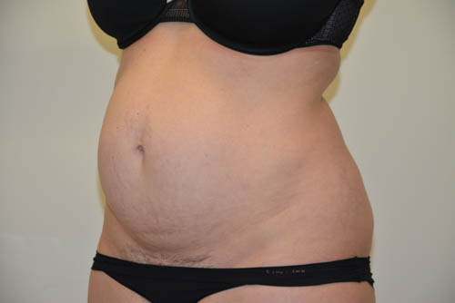 Tummy-Tuck-17 | Before Tummy Tuck 5