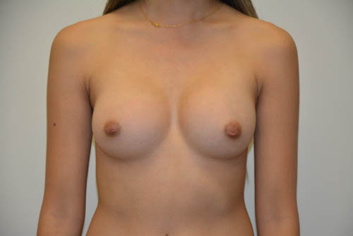 Breast-Augmentation-17 | After Breast Augmentation