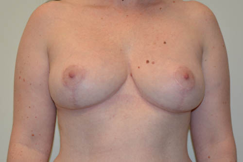 Breast-Reduction-17 | After Breast Reduction