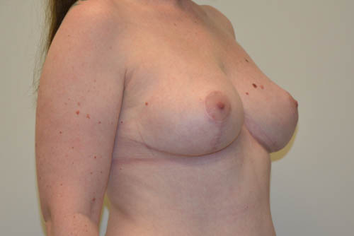 Breast-Reduction-17 | After Breast Reduction 2