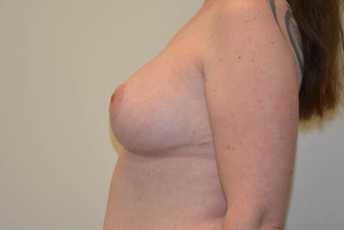 Breast-Reduction-17 | After Breast Reduction 5