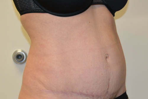Tummy-Tuck-17 | After Tummy Tuck 2