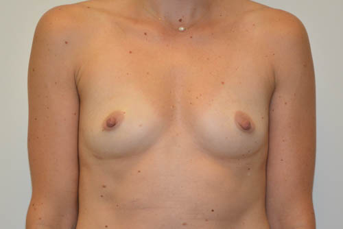Breast-Augmentation-18 | Before Breast Augmentation