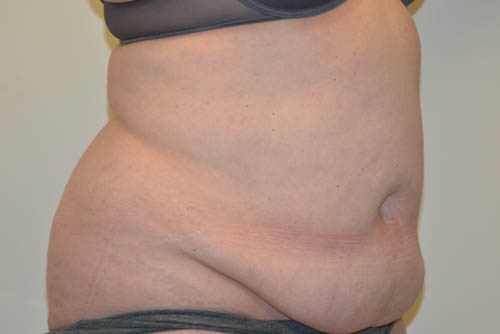 Tummy-Tuck-18 | Before Tummy Tuck 2
