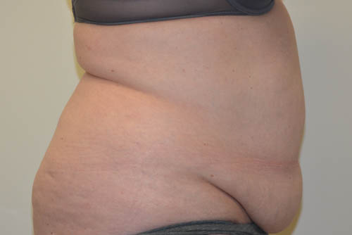Tummy-Tuck-18 | Before Tummy Tuck 3