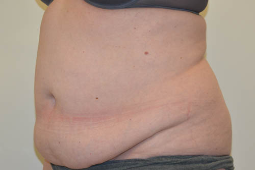 Tummy-Tuck-18 | Before Tummy Tuck 4