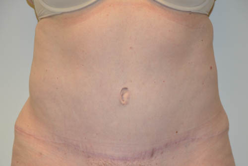 Tummy-Tuck-18 | After Tummy Tuck
