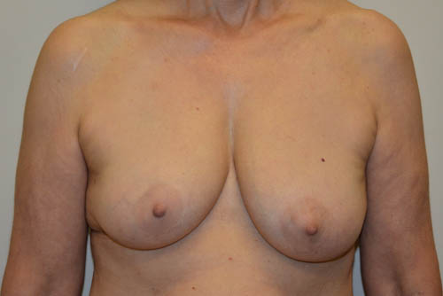Breast-Reconstruction-Tissue-Expanders-18 | Before Breast Reconstruction Tissue Expanders