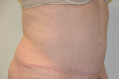 Tummy-Tuck-18 | After Tummy Tuck 2