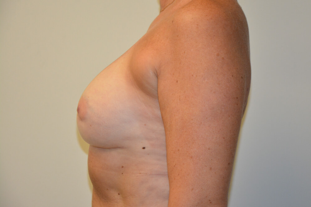 Breast-Revision-18 | After Breast Revision 3