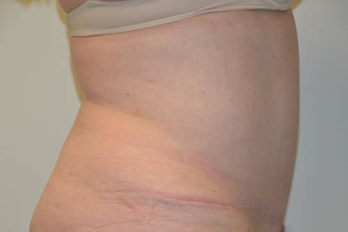Tummy-Tuck-18 | After Tummy Tuck 3