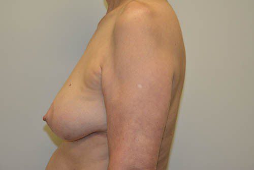 Breast-Reconstruction-Tissue-Expanders-18 | Before Breast Reconstruction Tissue Expanders 3