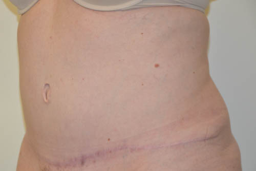 Tummy-Tuck-18 | After Tummy Tuck 4