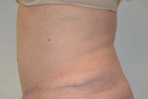 Tummy-Tuck-18 | After Tummy Tuck 5