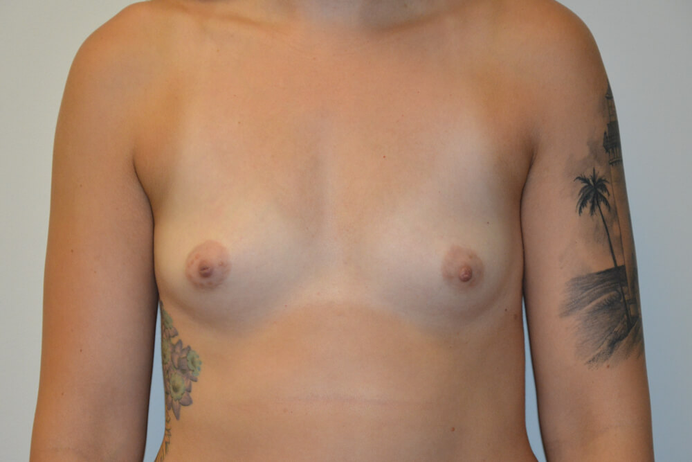 Breast-Augmentation-19 | Before Breast Augmentation