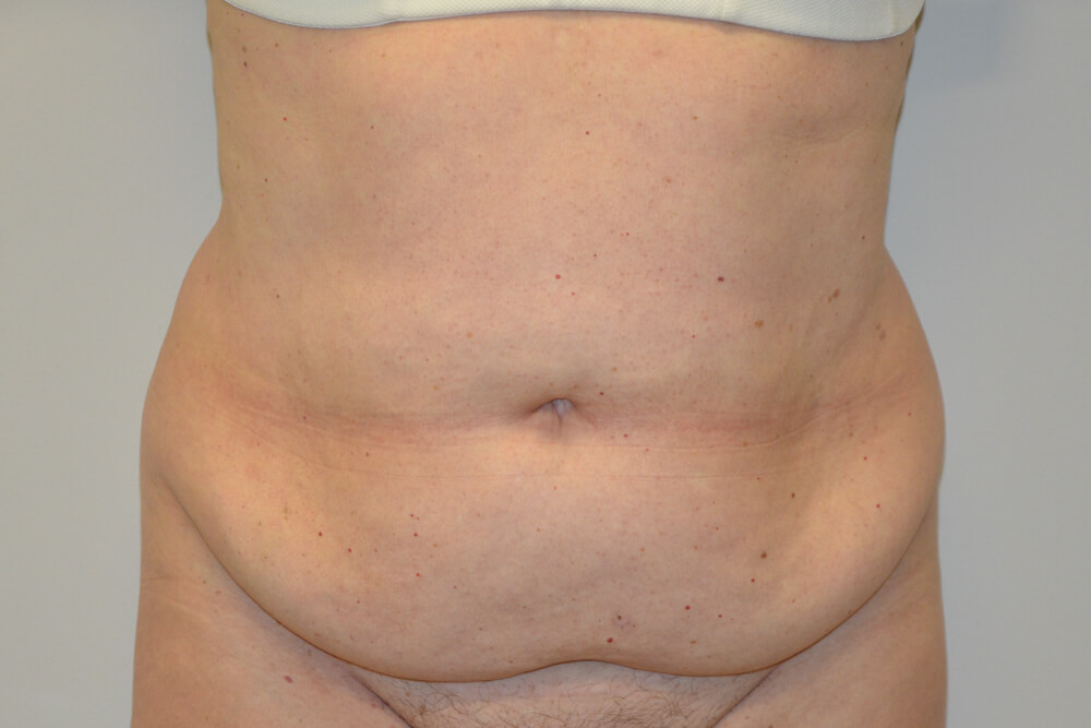 Tummy-Tuck-19 | Before Tummy Tuck