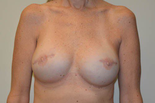 Breast-Reconstruction-Tissue-Expanders-19 | After Breast Reconstruction Tissue Expanders