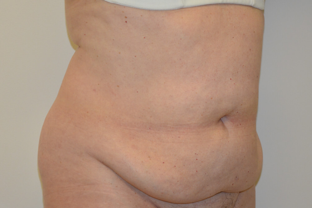 Tummy-Tuck-19 | Before Tummy Tuck 2