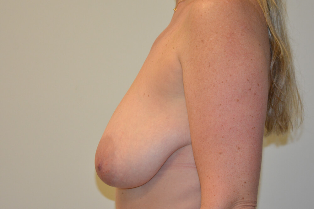 Breast-Reduction-19 | Before Breast Reduction 3