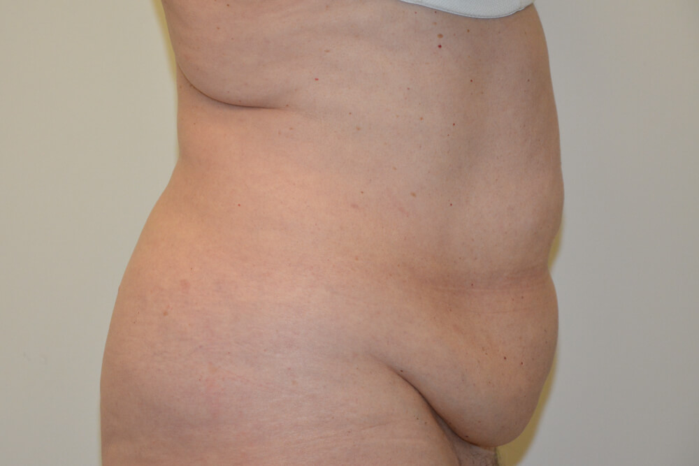 Tummy-Tuck-19 | Before Tummy Tuck 3