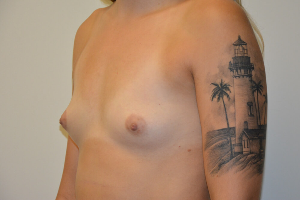Breast-Augmentation-19 | Before Breast Augmentation 4