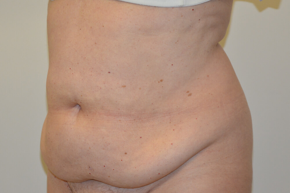 Tummy-Tuck-19 | Before Tummy Tuck 4