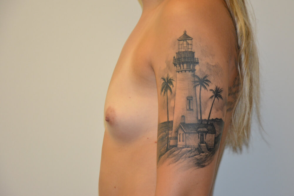Breast-Augmentation-19 | Before Breast Augmentation 5