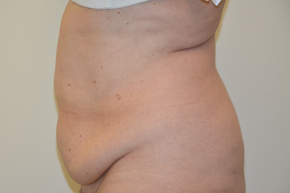 Tummy-Tuck-19 | Before Tummy Tuck 5