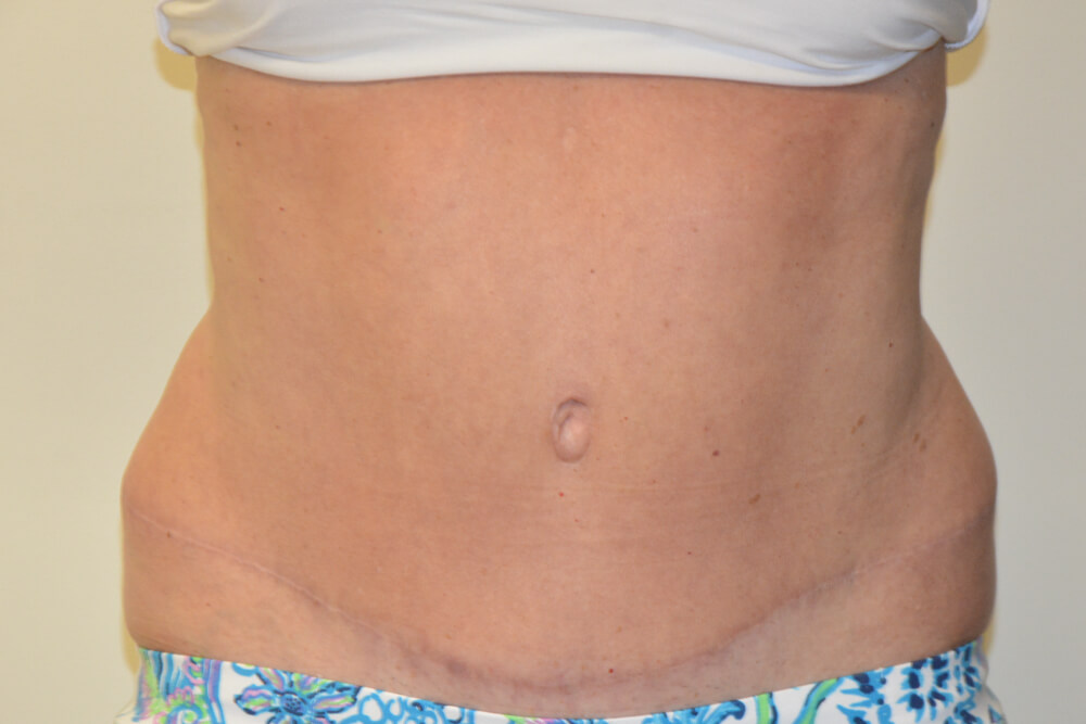 Tummy-Tuck-19 | After Tummy Tuck