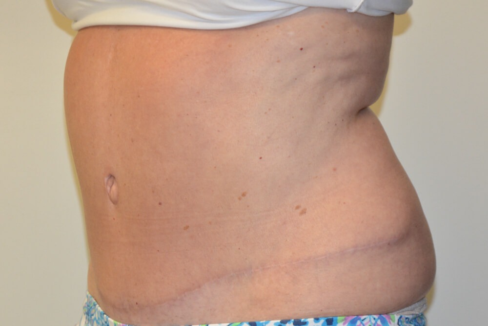 Tummy-Tuck-19 | After Tummy Tuck 4